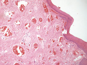 Fig. 12 Notare le angiectasie del corion. Il rivestimento epiteliale superficiale in questo tratto risulta appiattito e composto da una decina di strati. Colorazione con Ematossilina-Eosina, ingrandimento 100x.