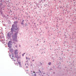 Fig. 13 La neoformazione in alcuni tratti presenta ulcerazione superficiale con essudato fibrino-purulento in cui sono compresi aggregati batterici. Colorazione con Ematossilina-Eosina, ingrandimento 200x.