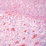 Fig. 14 Tessuto infiammatorio ricco in vasi neoformati con endoteli rigonfi, probabile esito di ulcerazione con successiva riepitelizzazione. Colorazione con Ematossilina-Eosina, ingrandimento 200x.