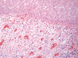 Fig. 14 Tessuto infiammatorio ricco in vasi neoformati con endoteli rigonfi, probabile esito di ulcerazione con successiva riepitelizzazione. Colorazione con Ematossilina-Eosina, ingrandimento 200x.