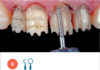 Fig. 8 Fase di preparazione mininvasiva degli elementi dentari.