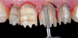 Fig. 8 Fase di preparazione mininvasiva degli elementi dentari.