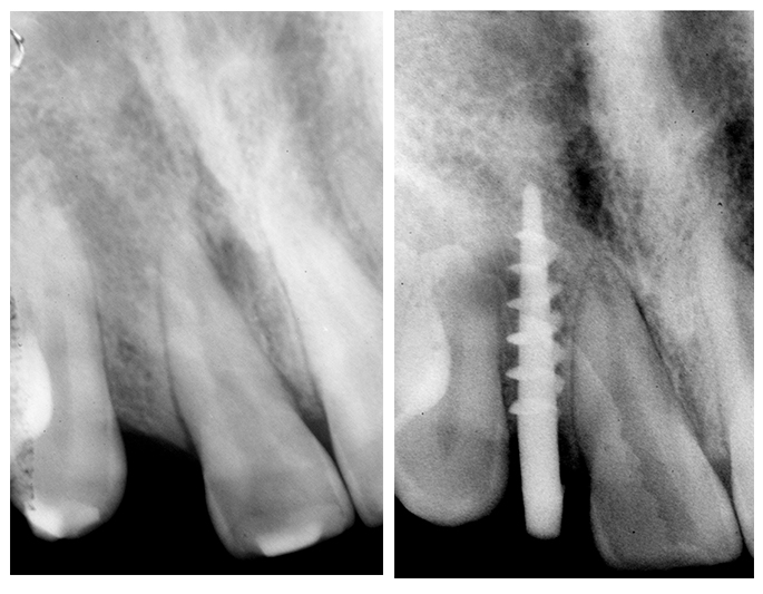 Fig. 11 La radiografia prima e dopo l’inserimento dell’impianto.