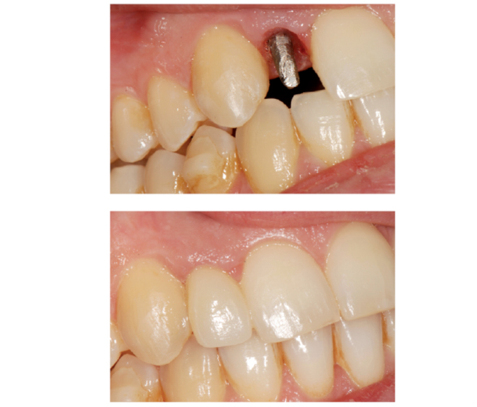 Fig. 12 La modellazione della mucosa perimplantare dopo la rimozione del provvisorio cementato al momento del termine dell’intervento. Sotto: il dente definitivo in metallo-ceramica.