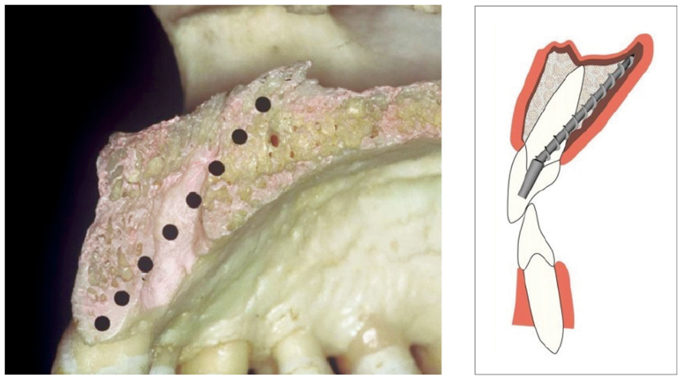 Fig. 4 La sezione anatomica e il disegno schematico del tragitto osseo sfruttato per l’inserimento di questa morfologia implantare. Con questa tecnica è possibile parallelizzare direttamente in bocca il moncone dell’impianto monofasico in rapporto ai denti contigui, considerata l’inclinazione.