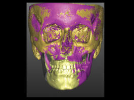 Superimposizione 3D Base Cranica VSP/FINALE (T2)