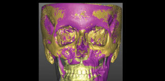 Superimposizione 3D Base Cranica VSP/FINALE (T2)
