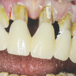 Le odontotomie eseguite sugli elementi dentari.