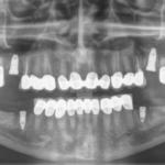 Rx OPT dopo cementazione degli elementi definitivi sui denti naturali, si nota come gli assi dei denti frontali siano stati spostati mesialmente e come le odontotomie non abbiano reso necessario la devitalizzazione dei denti. Le terapie canalari sono state eseguite solo sui secondi premolari che risultavano molto sensibili al freddo.