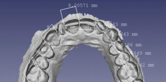 Figura 1. File STL ricavati da una scansione di una doppia di modelli in gesso (arcata superiore e inferiore) con relative misurazioni dell’ampiezza dentale mesio-distale dentale.