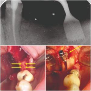 Figura 11. Atrofia mandibolare risolta con la chirurgia piezoelettrica e implantologia a lama (2010).