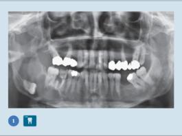 inclusione terzo molare