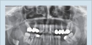 inclusione terzo molare