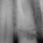 Fig. 1a Radiografia periapicale pre-operatoria.