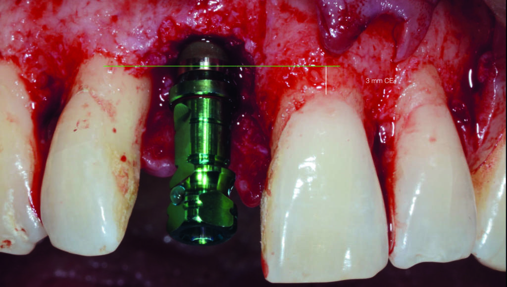 Fig. 7 Posizionamento dell’impianto (3 mm apicalmente alla CEJ dei denti adiacenti).