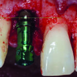 Fig. 7 Posizionamento dell’impianto (3 mm apicalmente alla CEJ dei denti adiacenti).