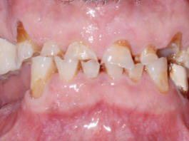 Fig. 1 Foto intra-orale frontale pre-operatoria.
