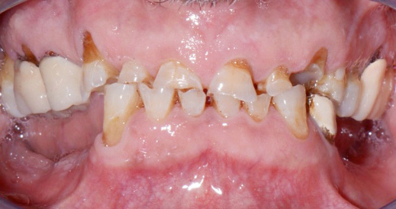 Fig. 1 Foto intra-orale frontale pre-operatoria.