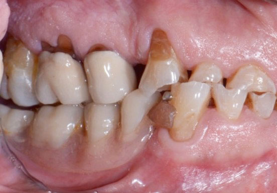 Fig. 2 Foto intra-orale laterale dx pre-operatoria.