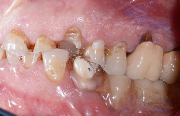 Fig. 3 Foto intra-orale laterale sx pre-operatoria.