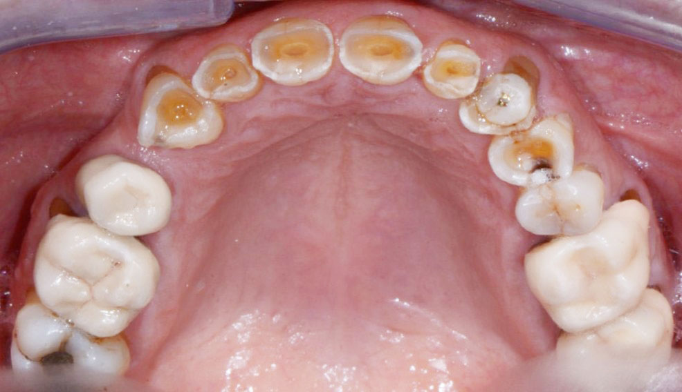 Fig. 4 Foto intra-orale occlusale superiore pre-operatoria.