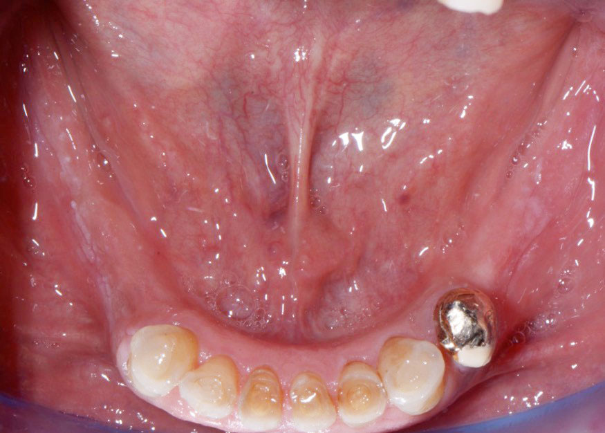 Fig. 5 Foto intra-orale occlusale inferiore pre-operatoria.