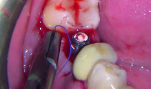 Fig. 14 Copertura dell’innesto con suture riassorbibili.