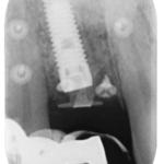 Fig. 11b Radiografia periapicale post-operatoria immediata.