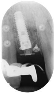 Fig. 11b Radiografia periapicale post-operatoria immediata.