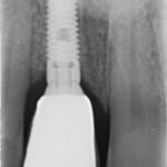 Fig. 19 Radiografia periapicale post carico.
