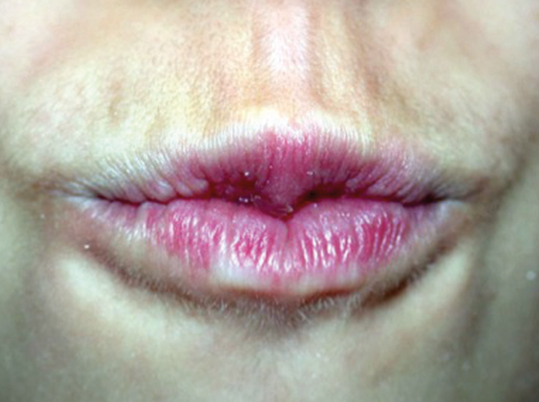 Foto paziente mentre esegue l’esercizio “baciomamma”.