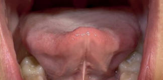 Fig. 1 Fotografia intraorale che mostra il frenulo linguale del paziente.