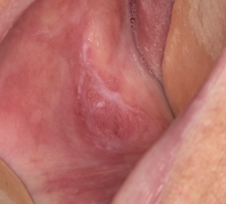 Fig. 11 Area lichenoide disomogenea della regione posteriore della guancia in paziente non fumatrice con pregresso carcinoma orale. Diagnosi della biopsia incisionale: displasia moderata.