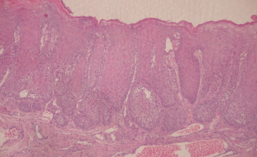 Fig. 14 Risultato istologico: carcinoma microinvasivo asportato in toto con margini e fondo indenni.