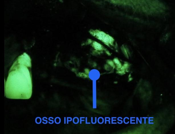 Fig. 8b Osteonecrosi mascellare in visione clinica diretta e in AF (autofluorescenza).