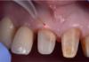 Fig. 1 Impiego del laser dopo la preparazione degli elementi dentali.