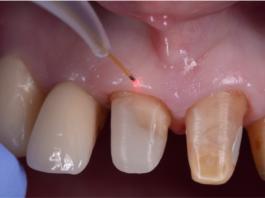 Fig. 1 Impiego del laser dopo la preparazione degli elementi dentali.
