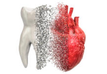 Malattie cardiovascolari ed endodonzia: lo stato dell’arte